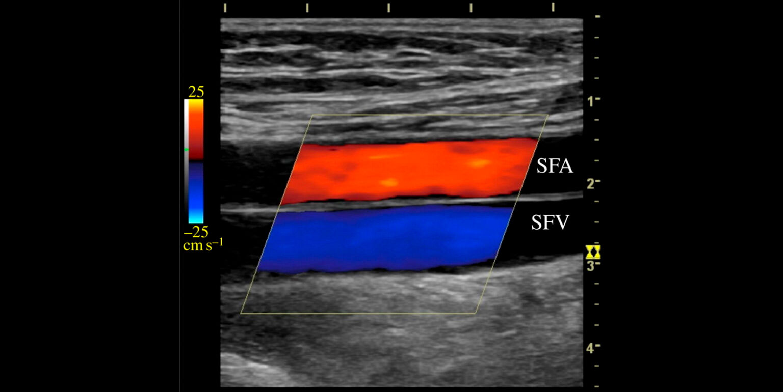 eco color doppler